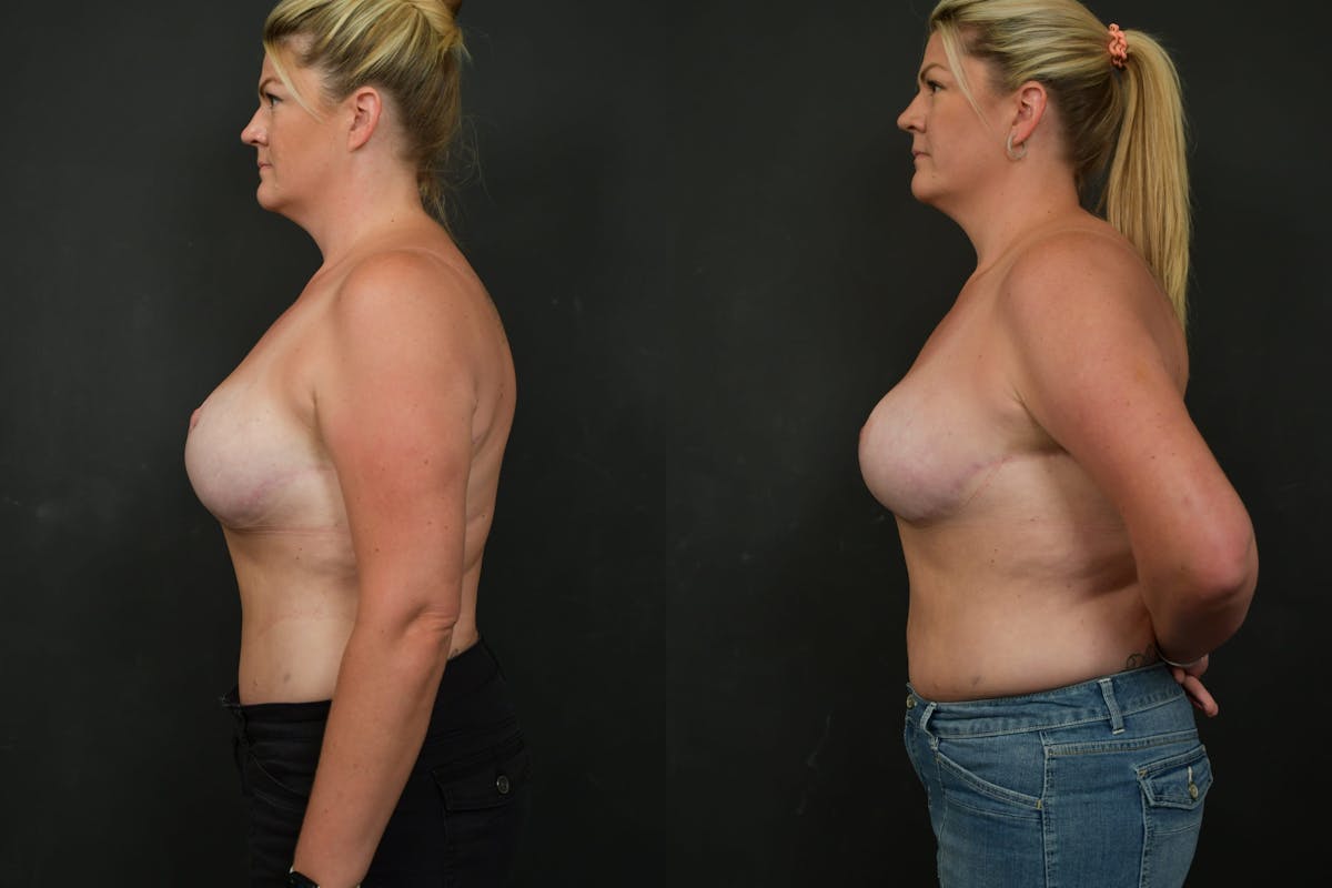 Breast Revision Before & After Gallery - Patient 252164 - Image 5