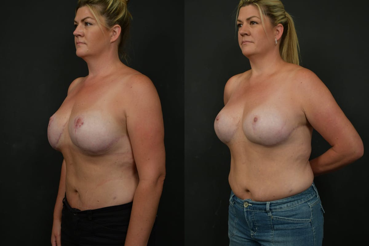 Breast Revision Before & After Gallery - Patient 252164 - Image 4