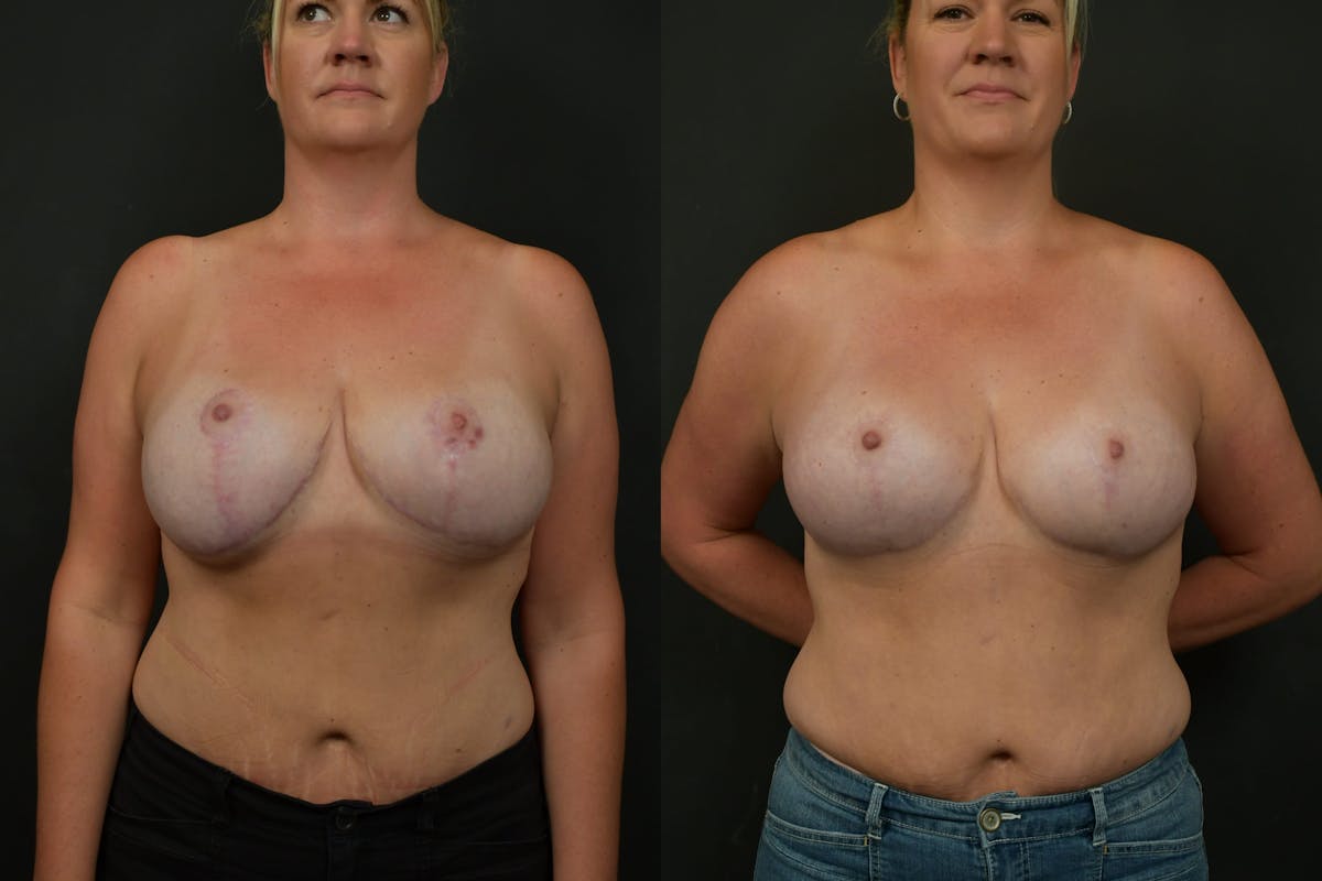 Breast Revision Before & After Gallery - Patient 252164 - Image 1