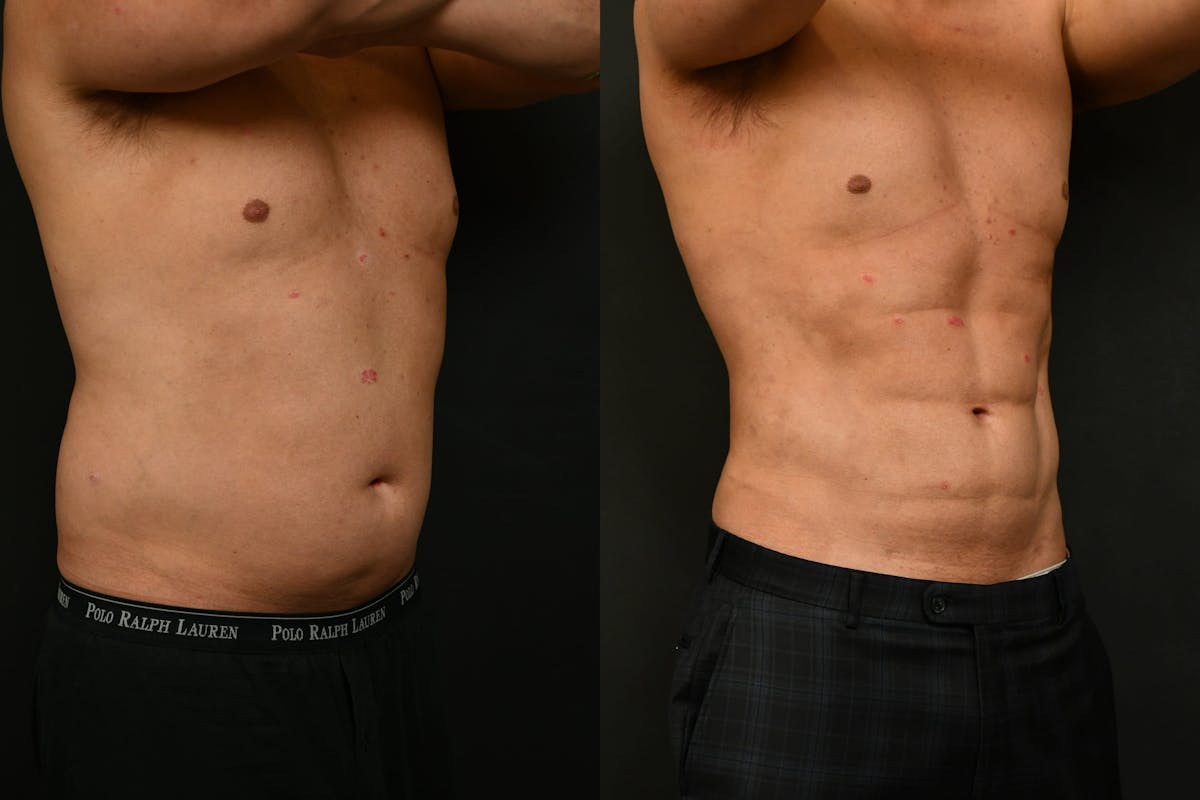 Adonis Before & After Gallery - Patient 146035 - Image 3