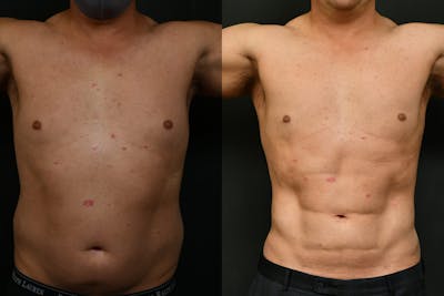 Adonis Before & After Gallery - Patient 146035 - Image 1