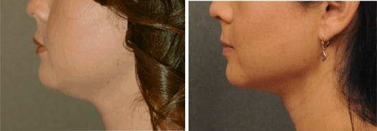 Neck Liposuction San Diego Plastic Surgery Blog