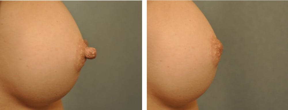 Before and After Nipple Reduction