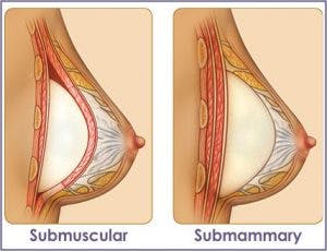Type of Breast implant replacement