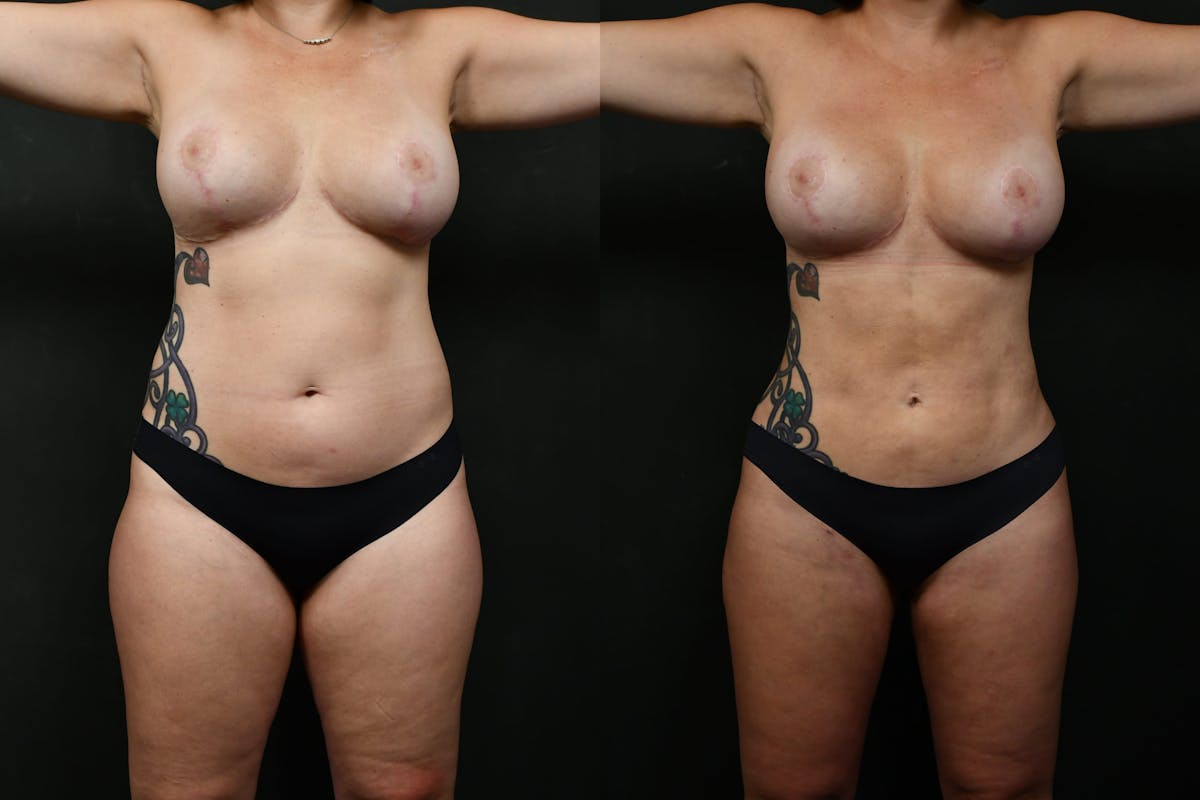 Liposuction Before & After Gallery - Patient 276285 - Image 1