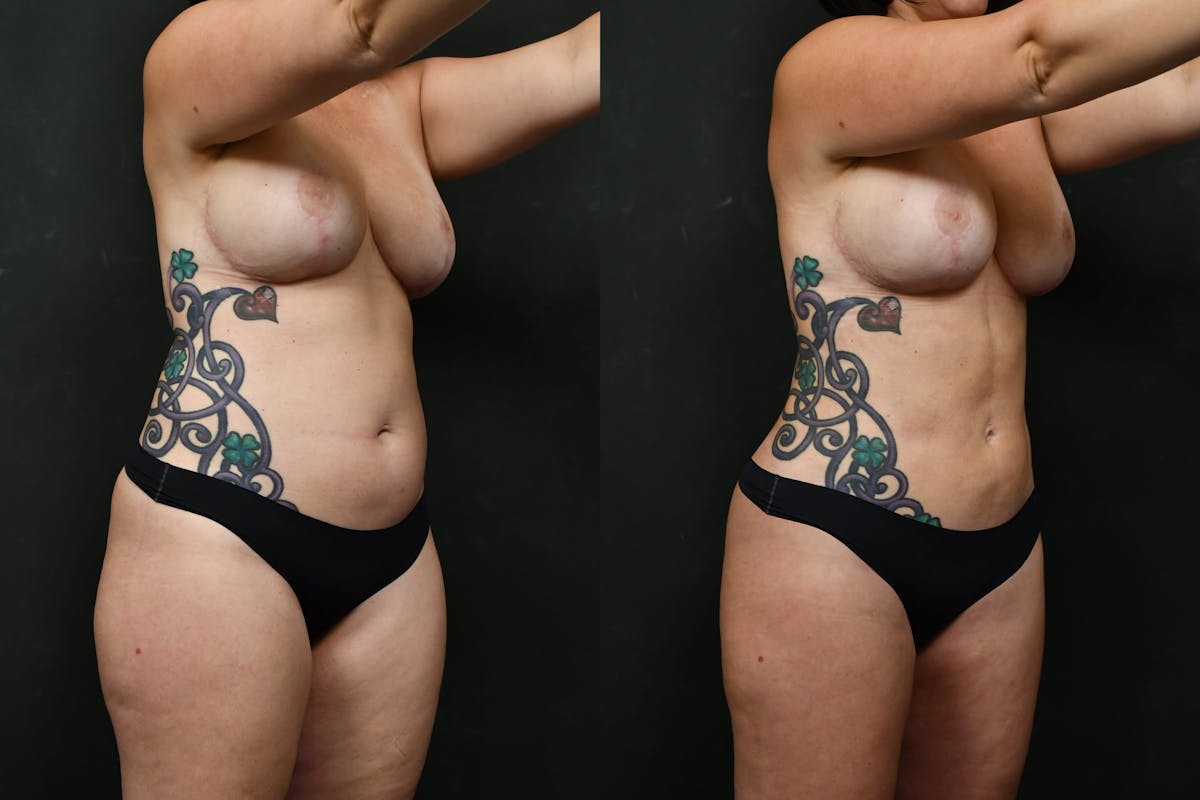 Liposuction / BodyTite Before & After Gallery - Patient 276285 - Image 2