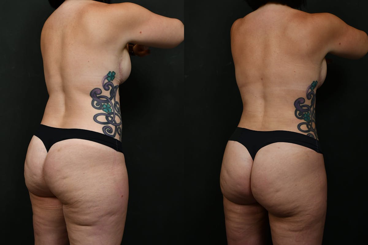 Liposuction / BodyTite Before & After Gallery - Patient 276285 - Image 4