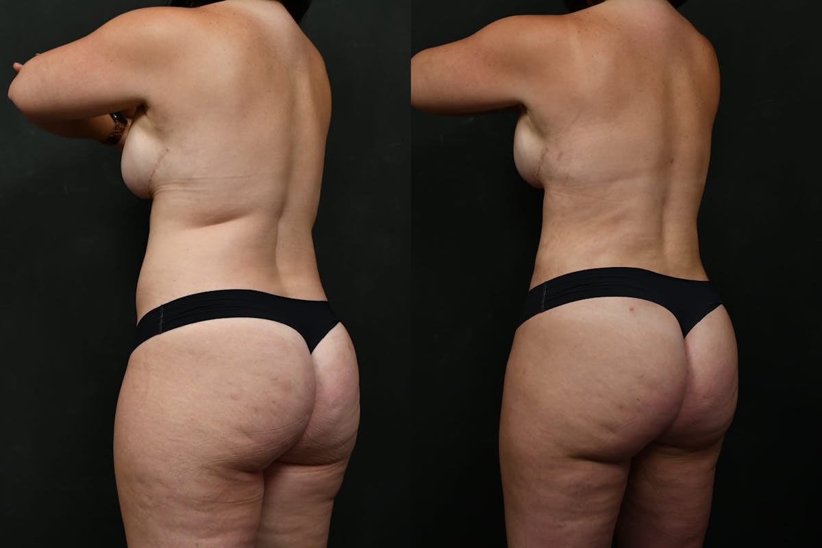 Liposuction / BodyTite Before & After Gallery - Patient 276285 - Image 6