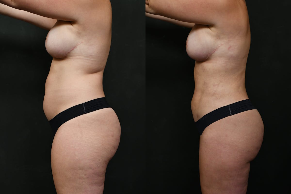 Liposuction / BodyTite Before & After Gallery - Patient 276285 - Image 7