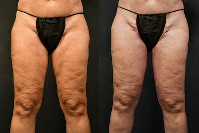 Thigh Lift Before & After Gallery - Patient 104735 - Image 1