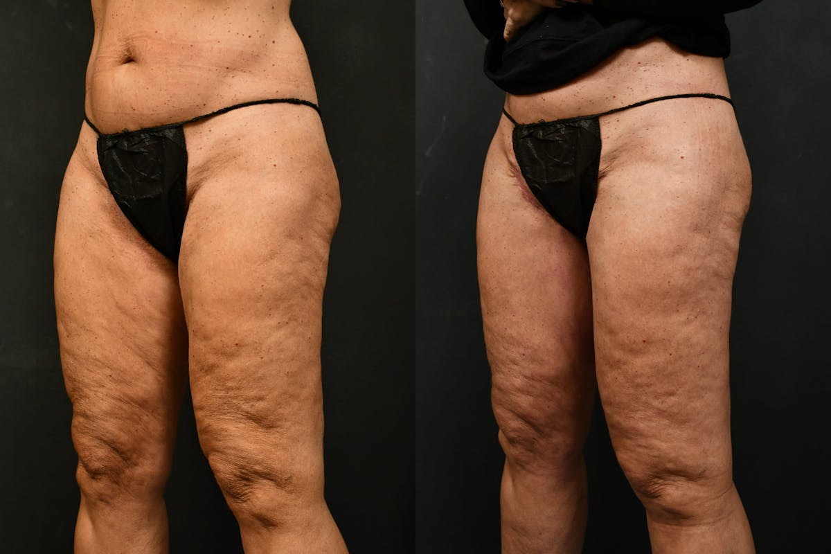 Thigh Lift Before & After Gallery - Patient 104735 - Image 2