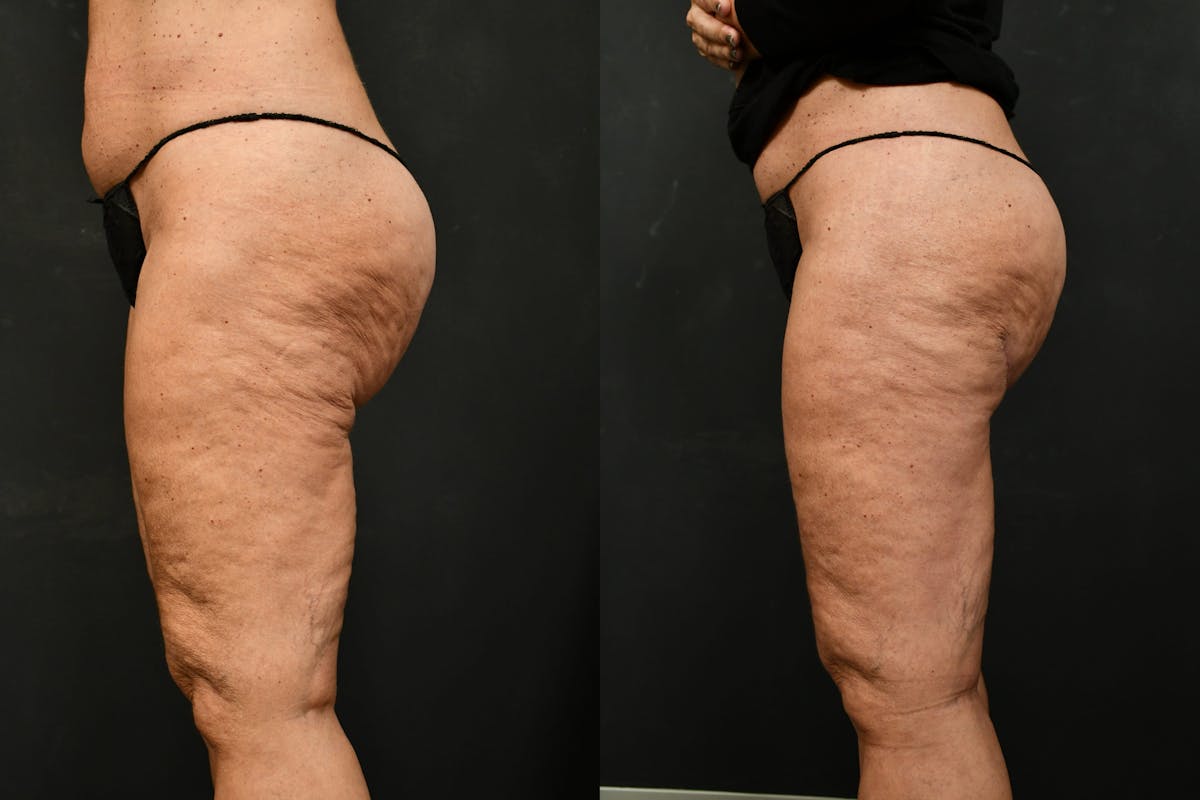 Thigh Lift Before & After Gallery - Patient 104735 - Image 3