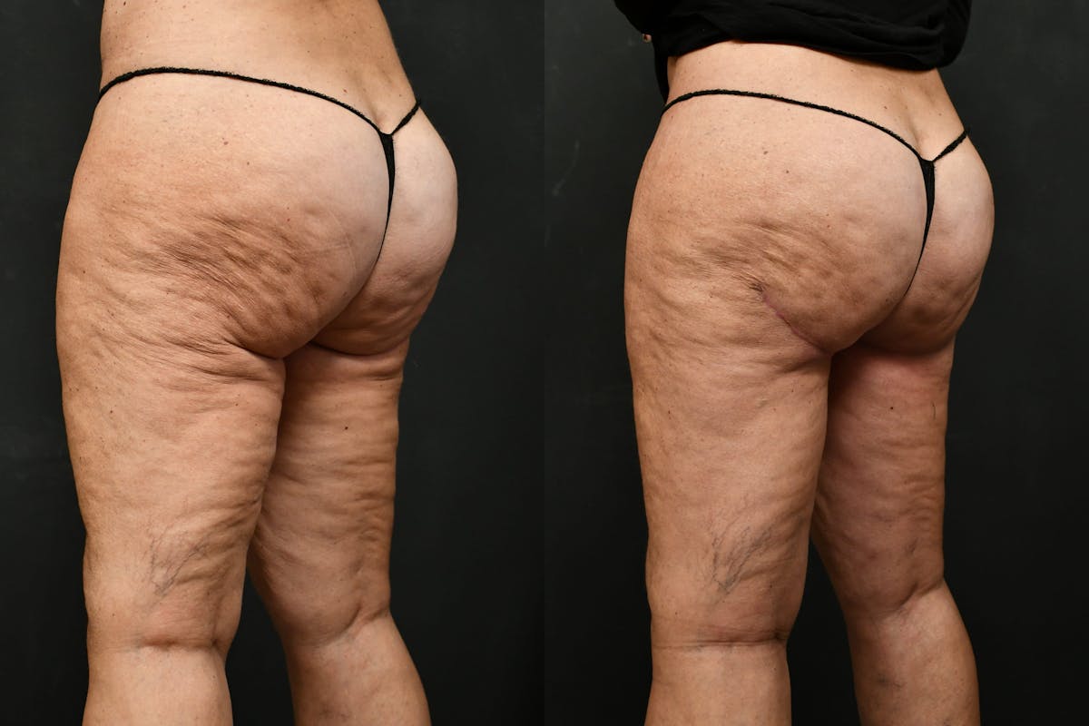 Thigh Lift Before & After Gallery - Patient 104735 - Image 4
