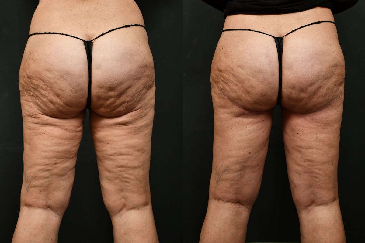 Thigh Lift Before & After Gallery - Patient 104735 - Image 5