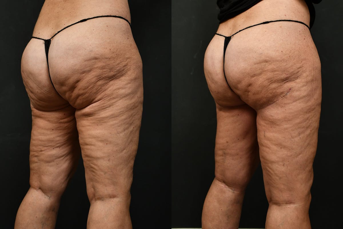 Thigh Lift Before & After Gallery - Patient 104735 - Image 6