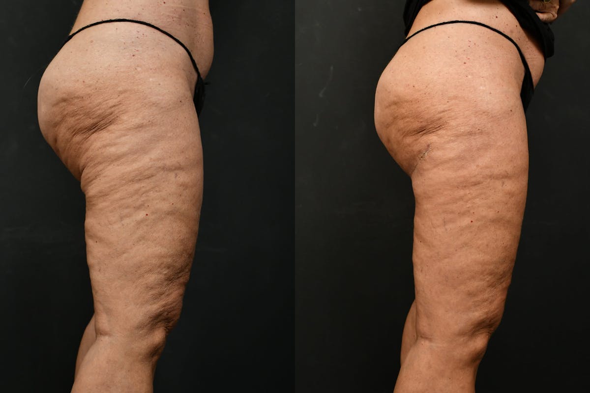 Thigh Lift Before & After Gallery - Patient 104735 - Image 7
