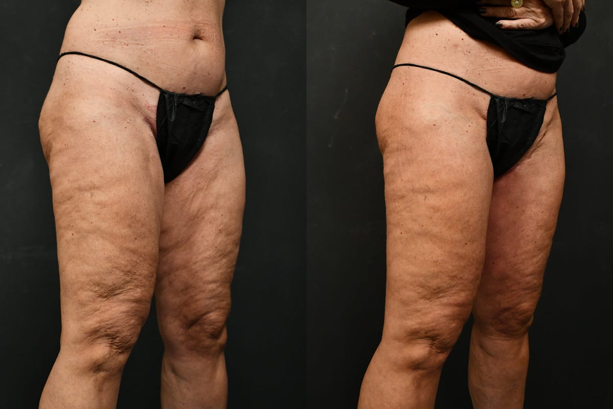Thigh Lift Before & After Gallery - Patient 104735 - Image 8