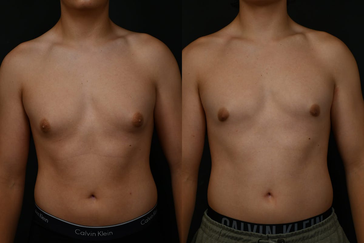 Gynecomastia Before & After Gallery - Patient 302802 - Image 1
