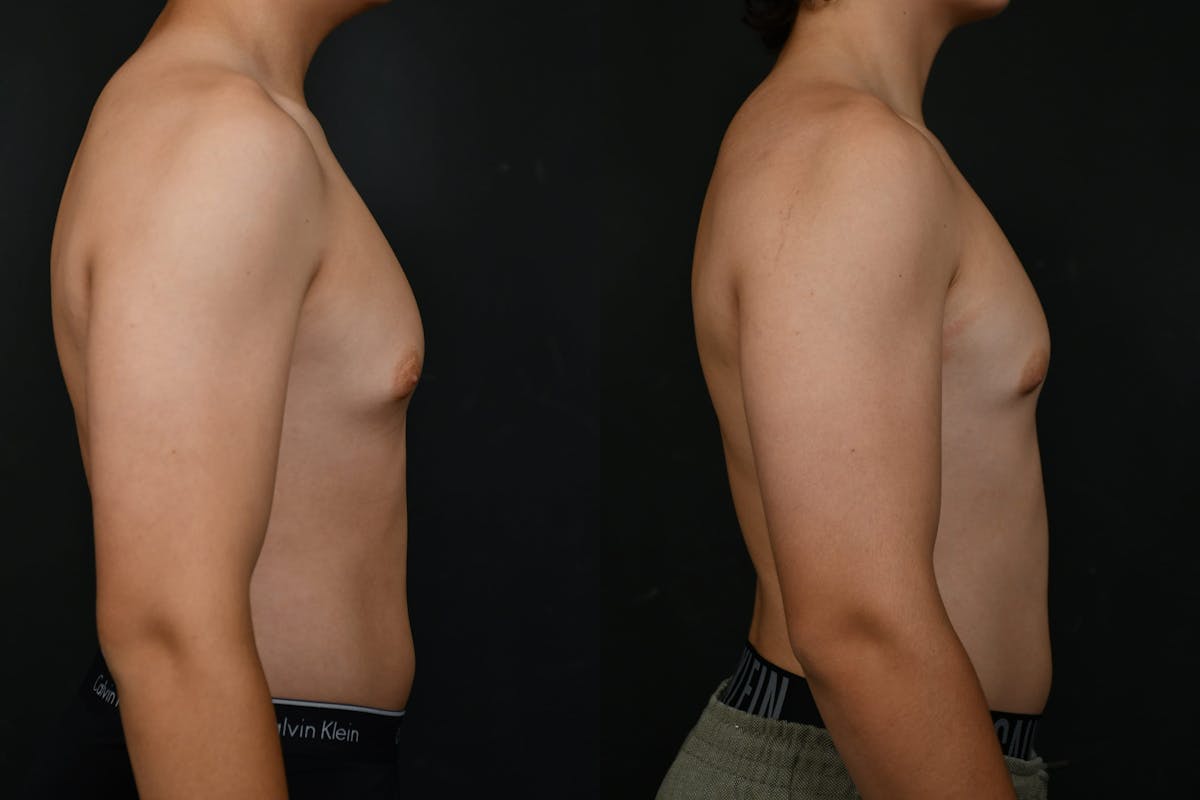 Gynecomastia Before & After Gallery - Patient 302802 - Image 3