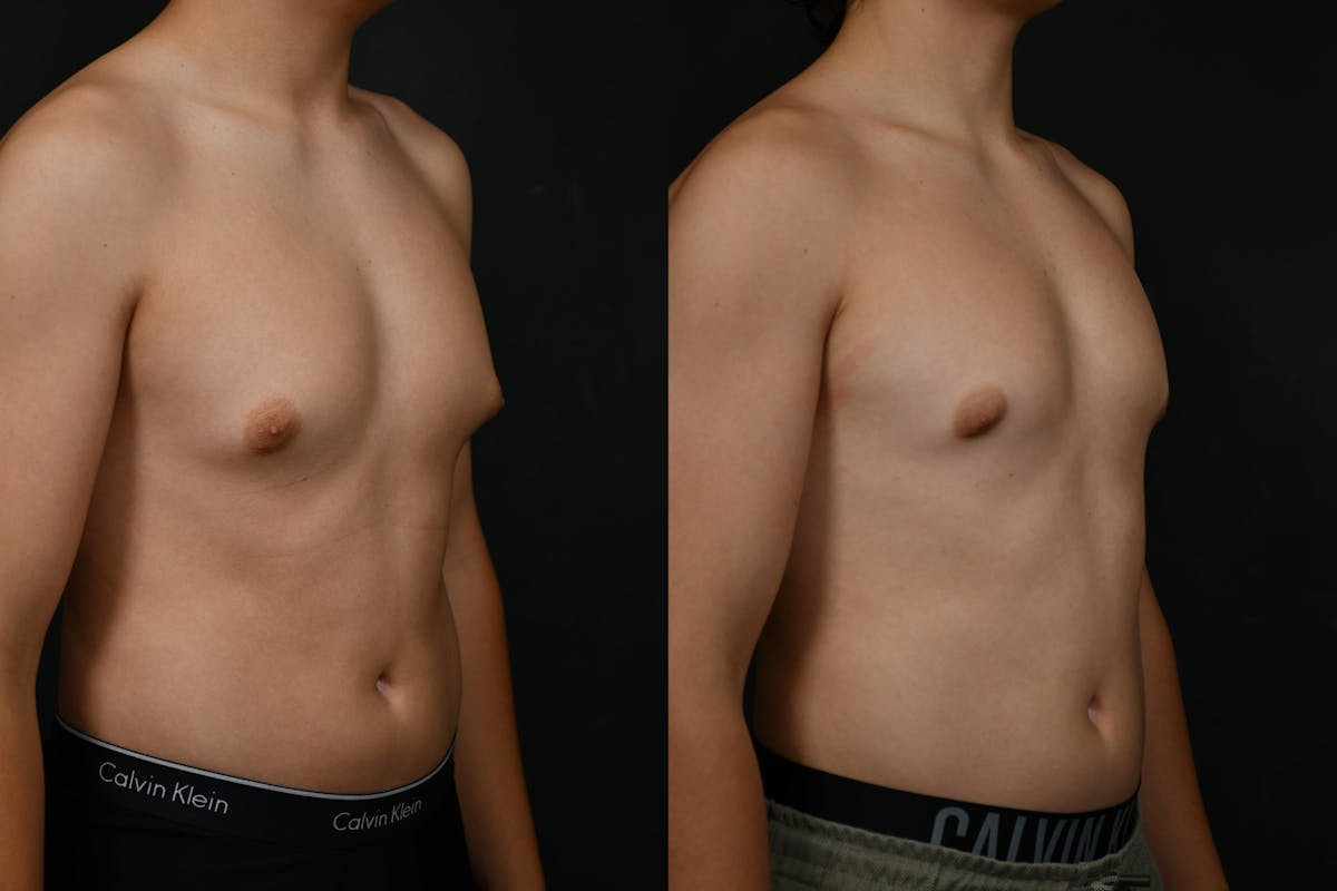 Gynecomastia Before & After Gallery - Patient 302802 - Image 2