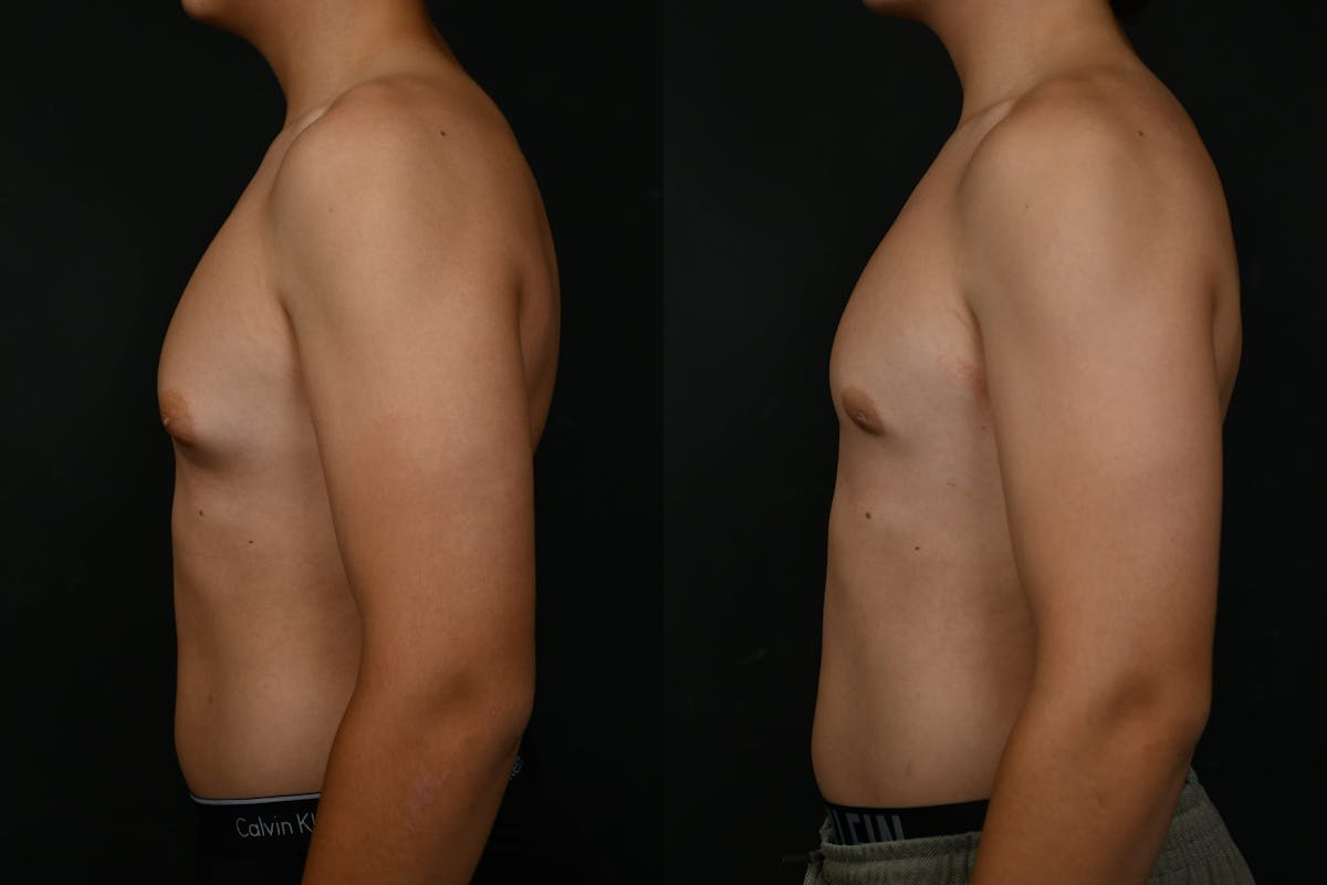Gynecomastia Before & After Gallery - Patient 302802 - Image 5