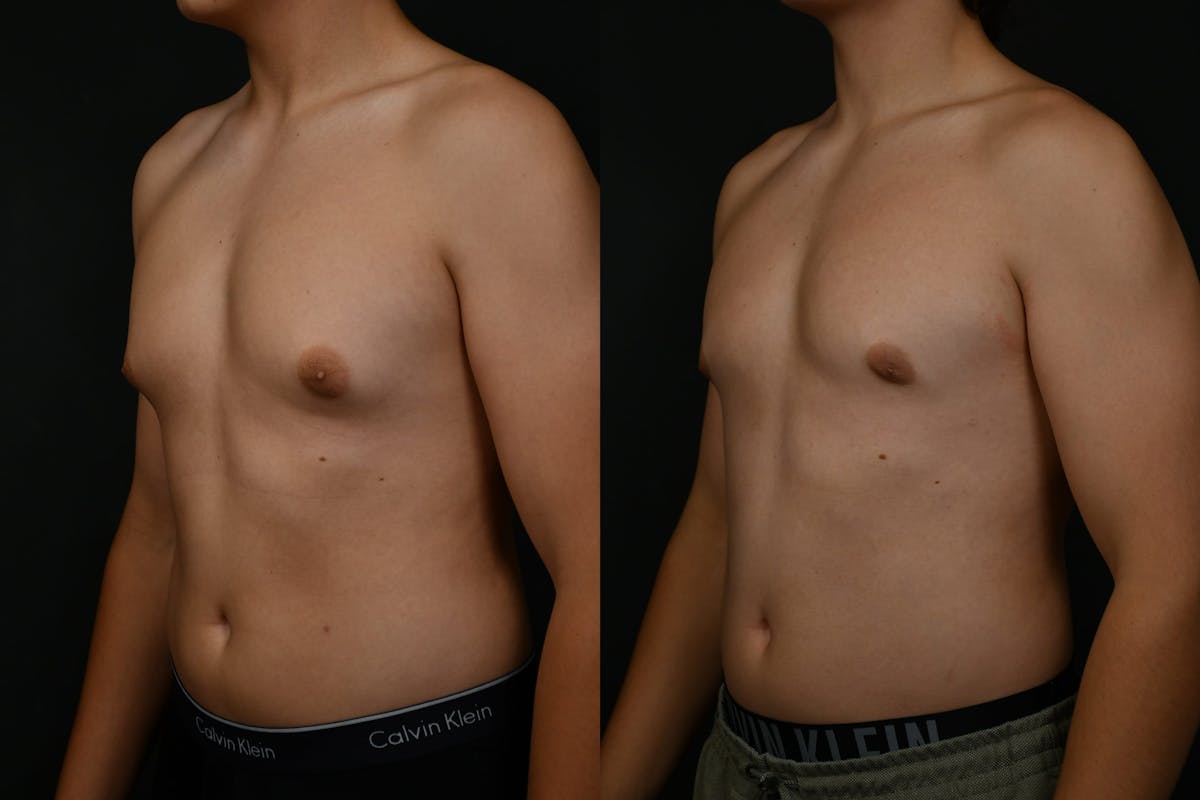 Gynecomastia Before & After Gallery - Patient 302802 - Image 4