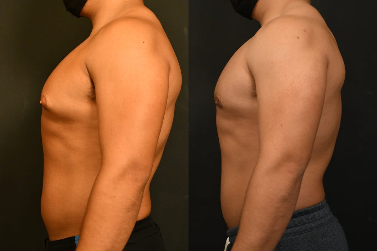 Gynecomastia Before & After Gallery - Patient 973282 - Image 3