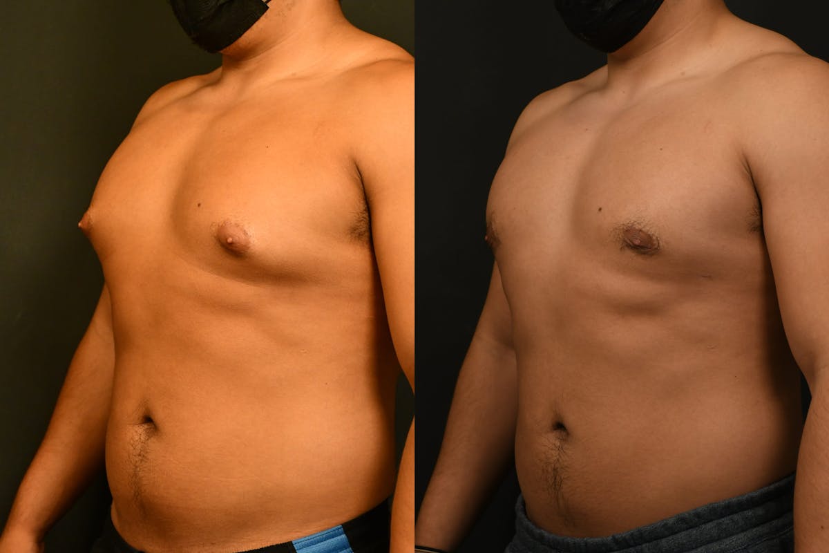 Gynecomastia Before & After Gallery - Patient 973282 - Image 2