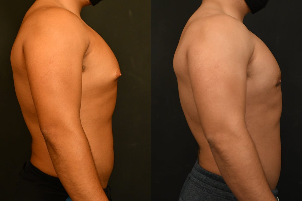 Gynecomastia Before & After Gallery - Patient 973282 - Image 5