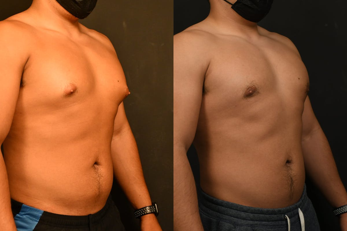 Gynecomastia Before & After Gallery - Patient 973282 - Image 4