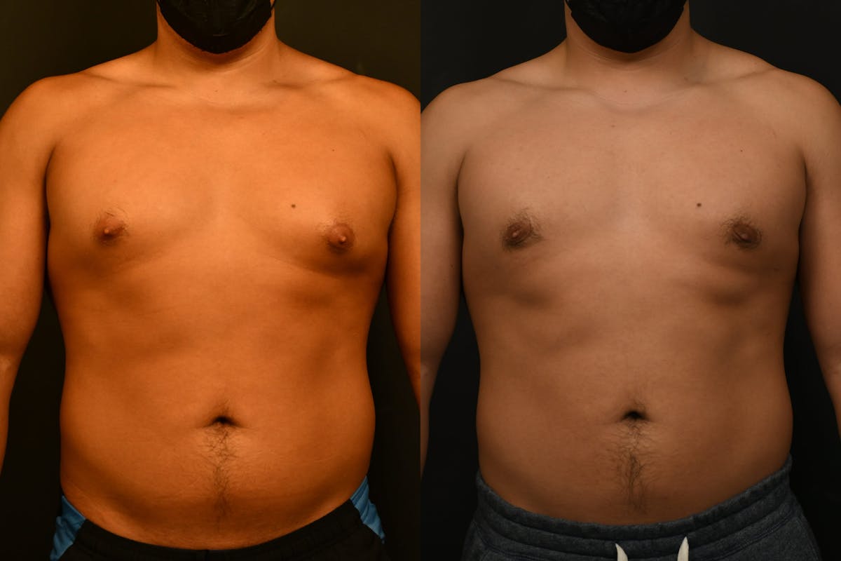 Gynecomastia Before & After Gallery - Patient 973282 - Image 1