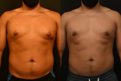 Gynecomastia Before & After Gallery - Patient 973282 - Image 1