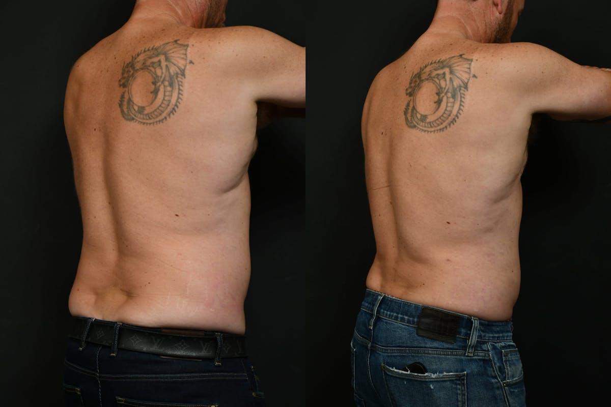 Liposuction Before & After Gallery - Patient 617510 - Image 2