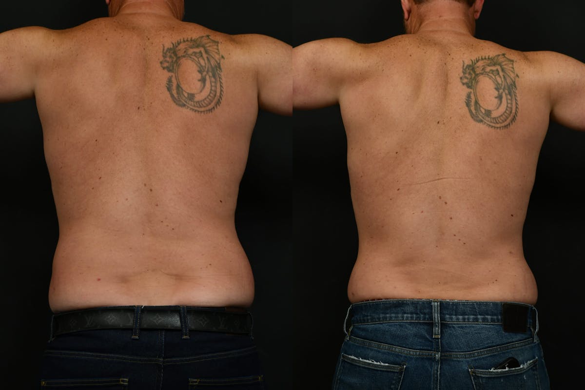 Liposuction Before & After Gallery - Patient 617510 - Image 3