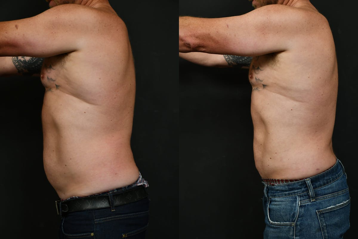 Liposuction Before & After Gallery - Patient 617510 - Image 7