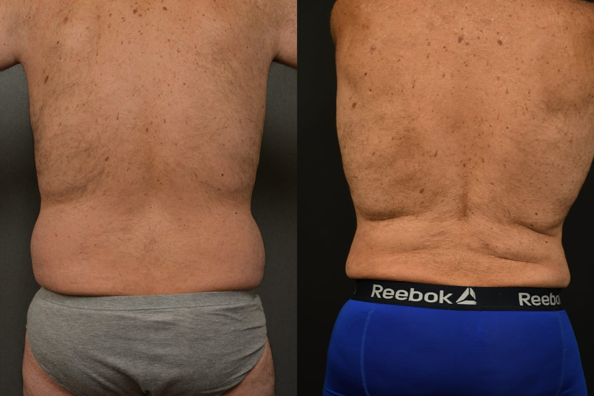 Liposuction Before & After Gallery - Patient 155735 - Image 2