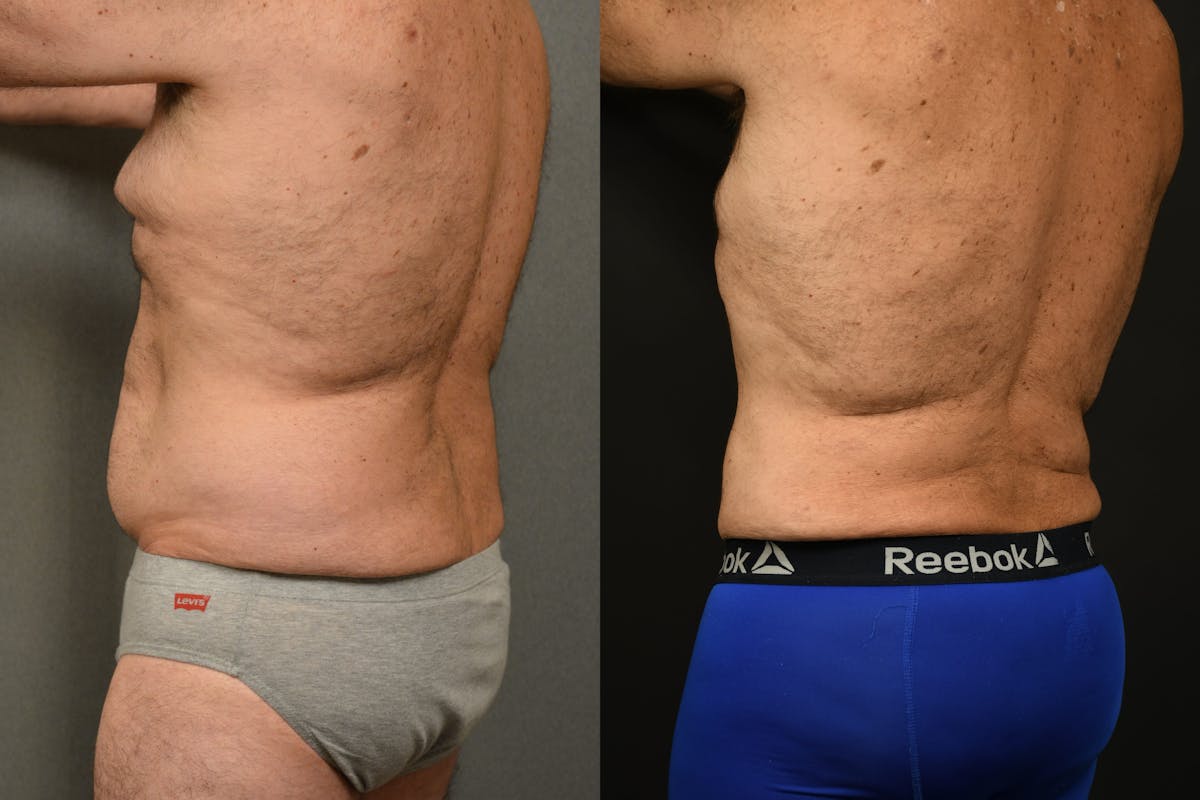 Liposuction Before & After Gallery - Patient 155735 - Image 3