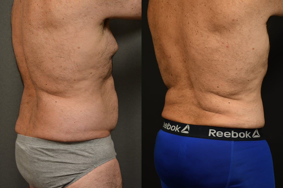 Liposuction Before & After Gallery - Patient 155735 - Image 4
