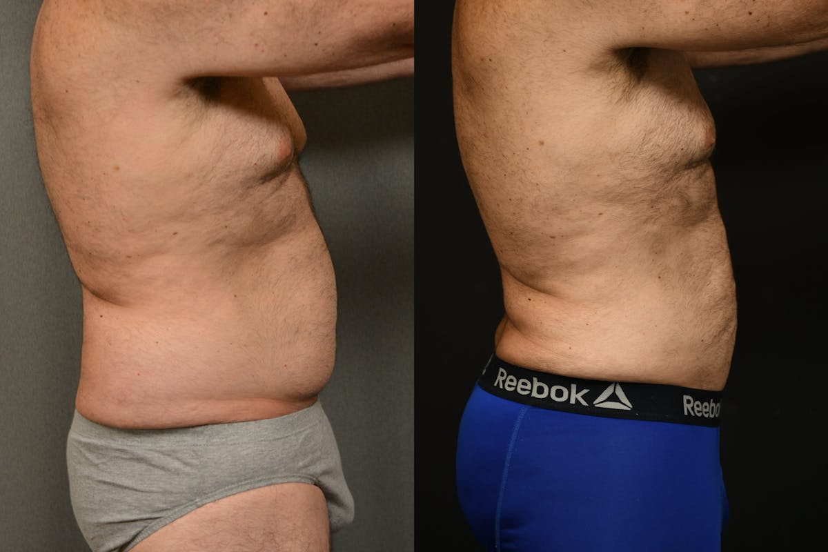 Liposuction Before & After Gallery - Patient 155735 - Image 5