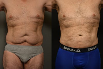 Liposuction Before & After Gallery - Patient 155735 - Image 1