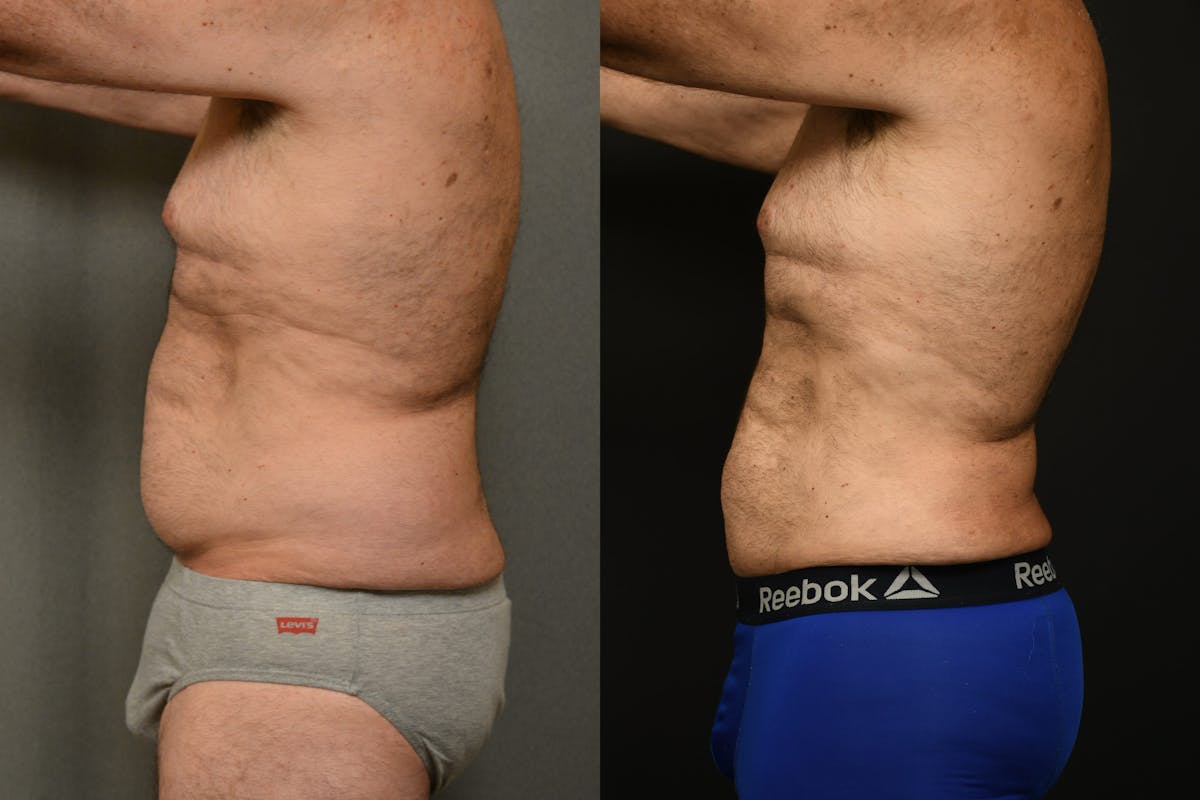Liposuction Before & After Gallery - Patient 155735 - Image 6
