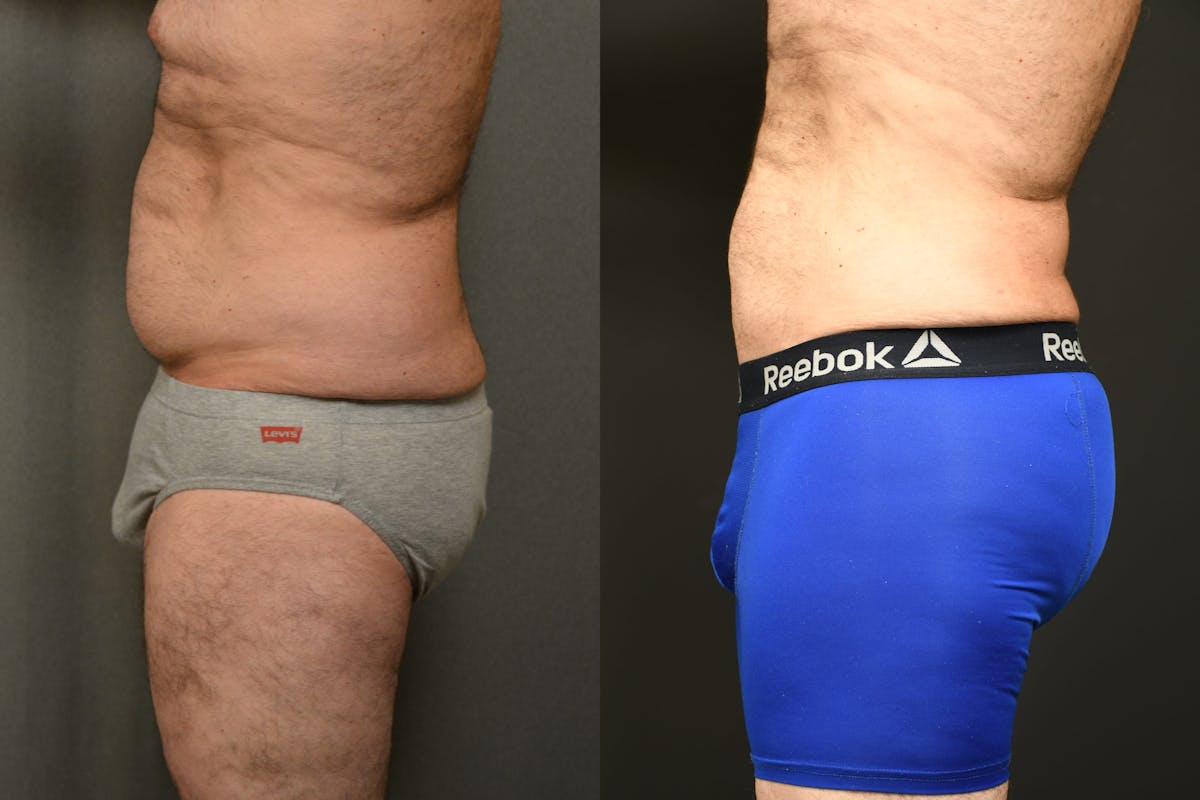 Liposuction Before & After Gallery - Patient 155735 - Image 7