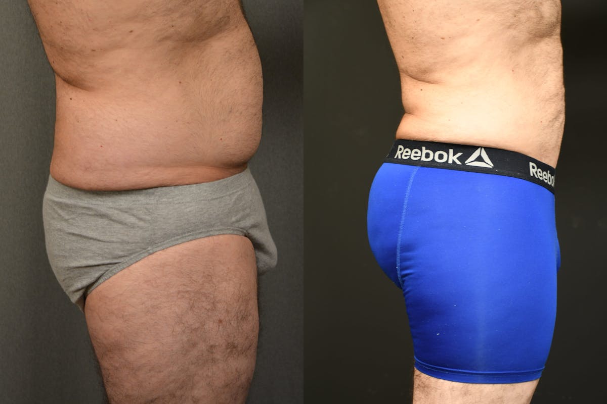 Liposuction Before & After Gallery - Patient 155735 - Image 8