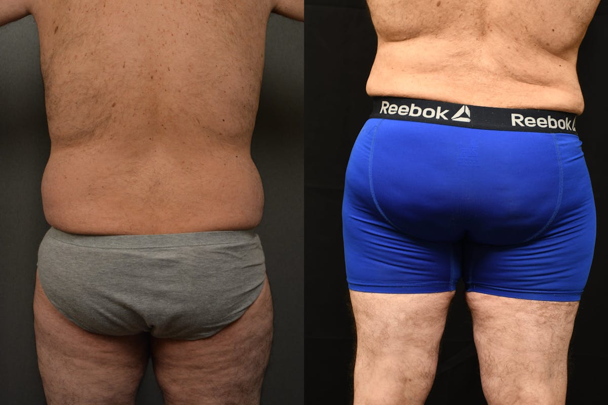 Liposuction Before & After Gallery - Patient 155735 - Image 9