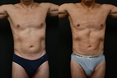 Liposuction Before & After Gallery - Patient 284397 - Image 1