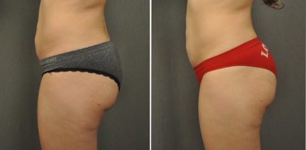 Brazilian Butt Lift cps