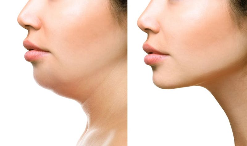 Before and After Kybella