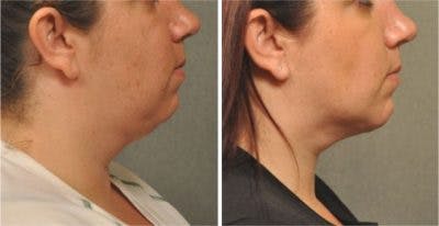 Before and after liposuction