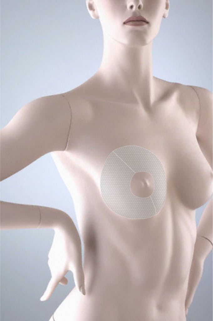 Mesh used in breast surgery