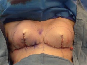 IntraOp TIGR mesh right